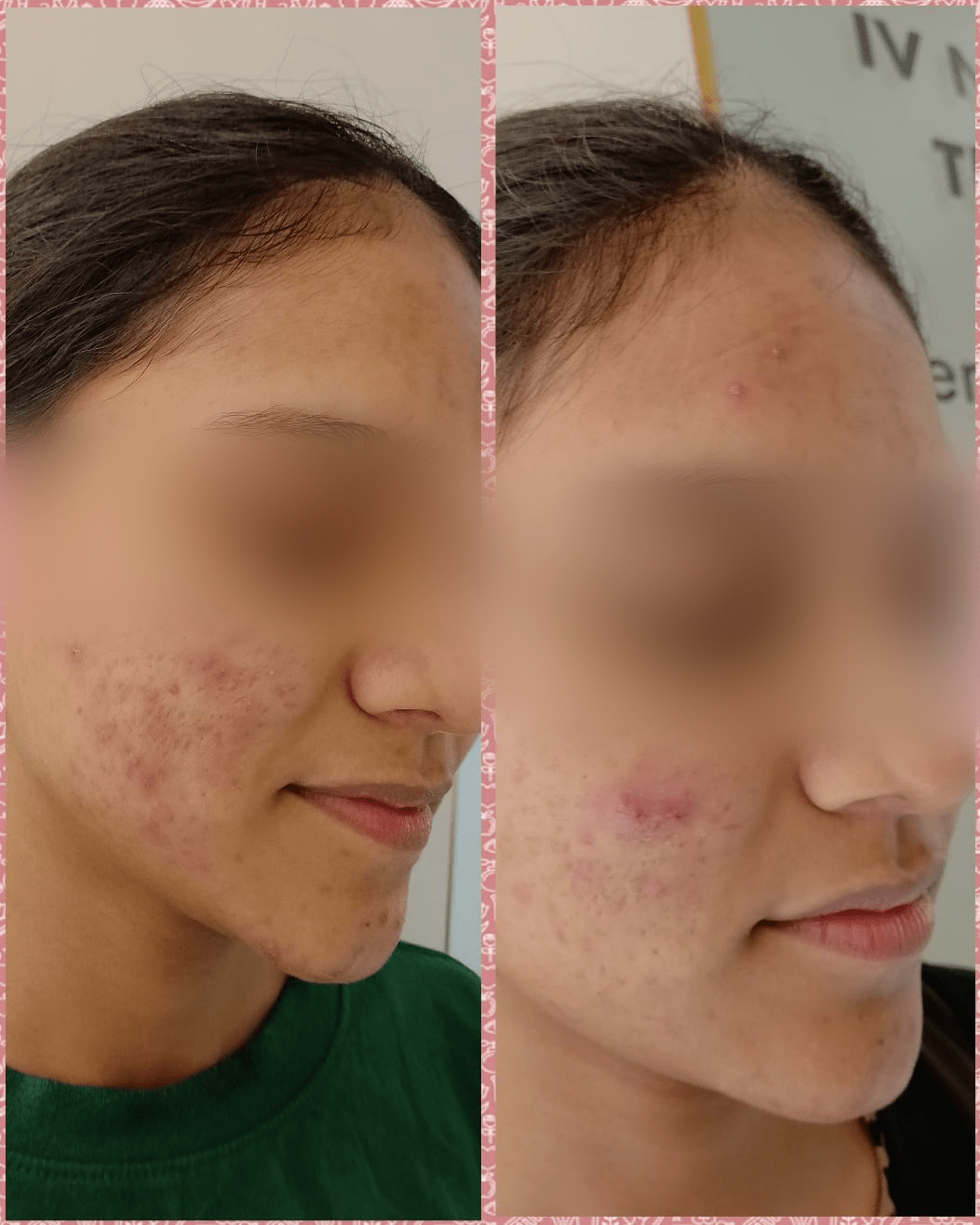 Acne & Black Peel