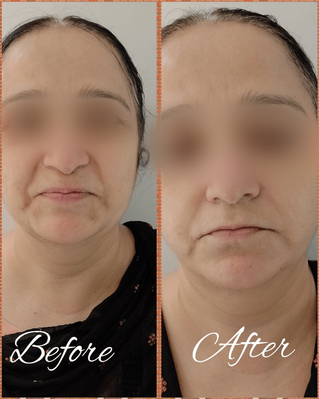 Anti-Ageing Facial