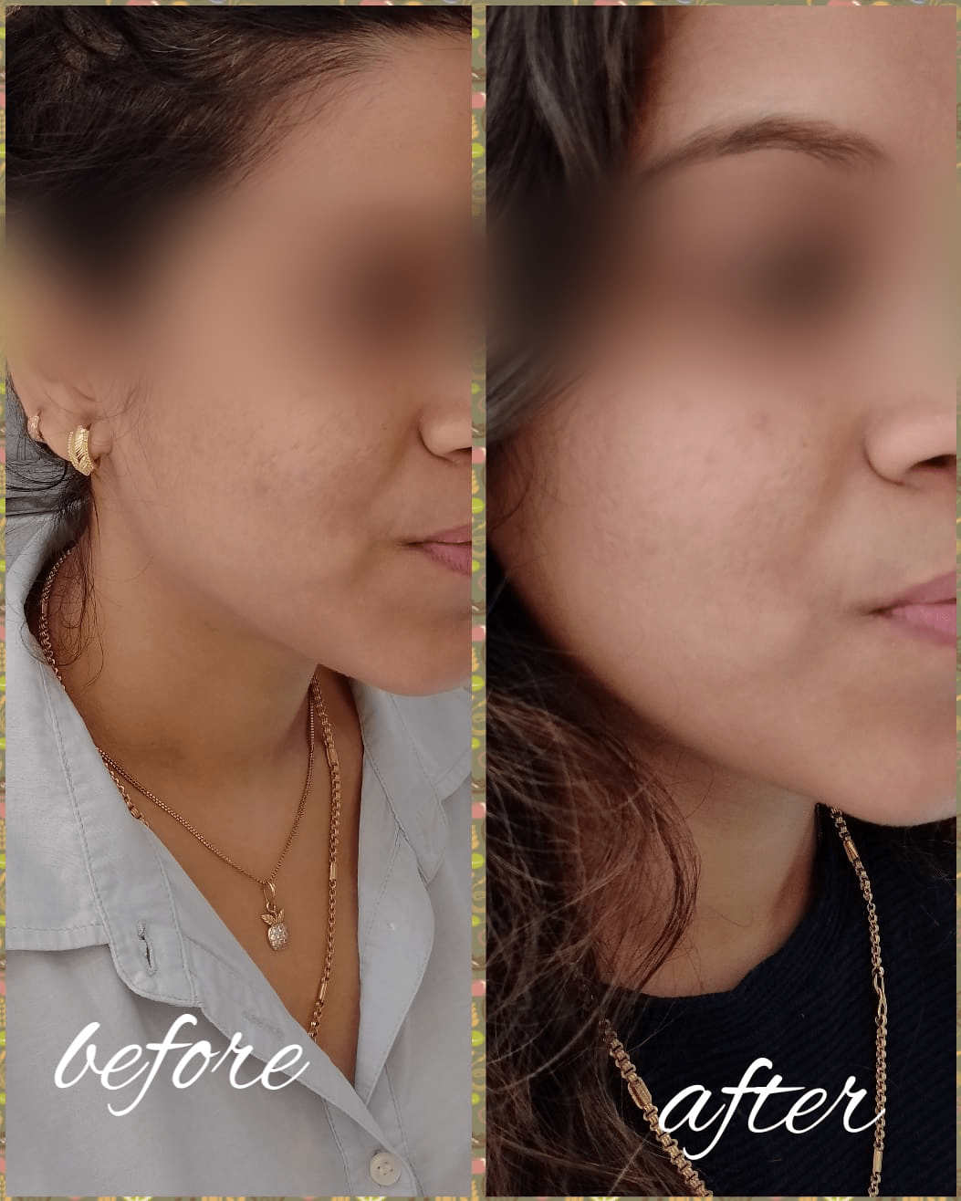 CO2 Laser Scar Reduction Treatment