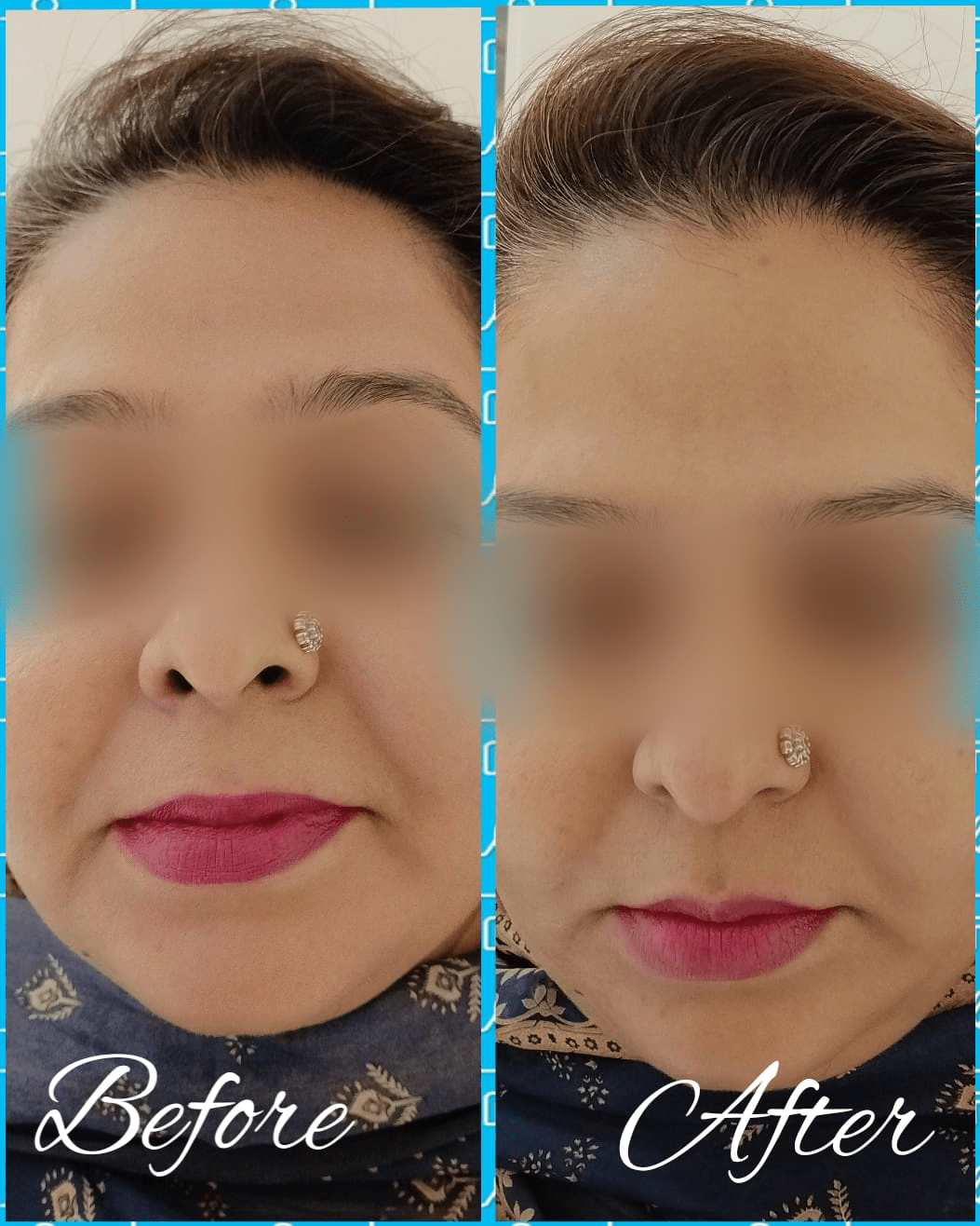 Hydra Facial (2)