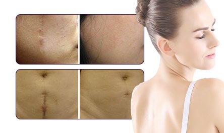 Scar Removal-min